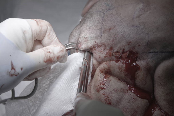 Tesoura cirúrgica em uma cabeça
 - Foto, Imagem