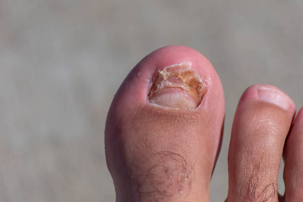 Unha grande dedo do pé quebrado e crescendo de volta após uma lesão
. - Foto, Imagem