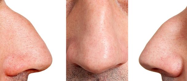 Аквилиновый нос
 - Фото, изображение