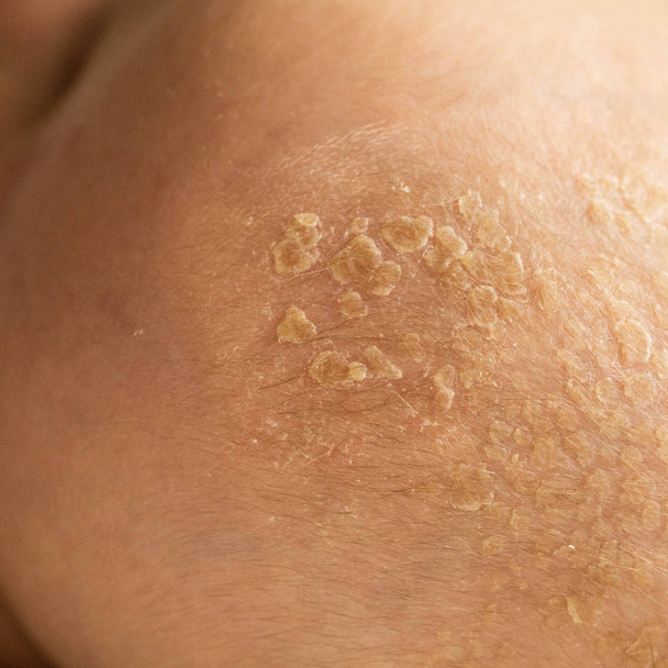 Baby crust on the head. Seborrheic crust on baby head, close-up, Seborrheic dermatitis, inflammatory.  - Photo, Image