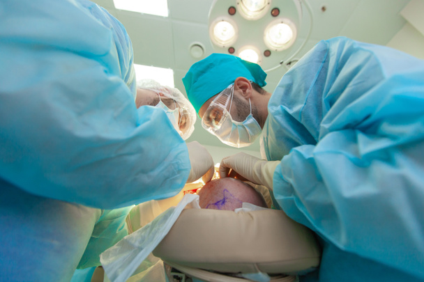 Kaalheid behandeling. Haartransplantatie. Chirurgen in de operatiekamer voeren haartransplantatiechirurgie uit. Chirurgische techniek die haarfollikels van een deel van het hoofd beweegt. - Foto, afbeelding