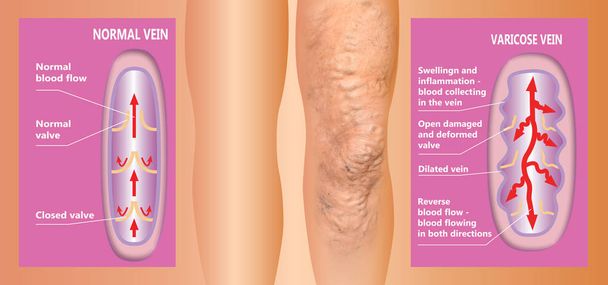 Varicose veins on a female senior legs. The structure of normal and varicose veins. - Photo, Image