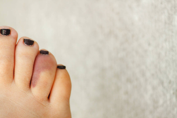 Fractured siniak czwartego palca na kobiecej stopy. Stylu życia. Kopiuj przestrzeń - Zdjęcie, obraz