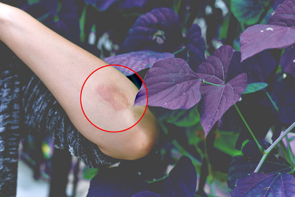 Problema de enfermedades alérgicas de la piel, Dermatitis por contacto con árboles venenosos erupción por planta, Paciente de dermatología femenina con eccema alérgico en el brazo
 - Foto, Imagen