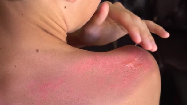 A young man with severe sunburn. Sunburn treatment: special burn ointment, salve, cream, gel. Burned skin - Footage, Video