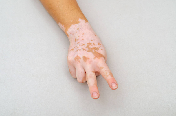 Vitiligo na kůži ruky. Gesto pro prsty na vítězi - Fotografie, Obrázek