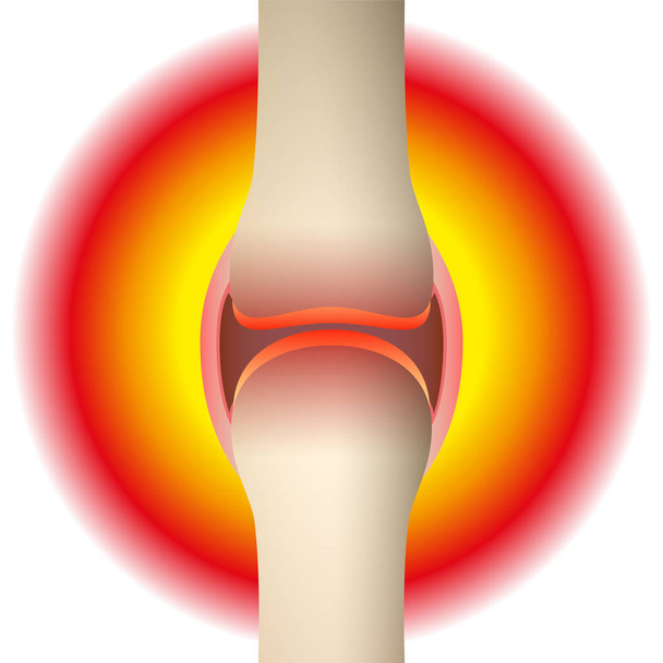 Біль у суглобах - схематична анатомічна графіка синовіального суглоба з артритом, ревматизмом, подагрою, остеоартритом або запаленням. Ізольовані Векторні ілюстрації на білому тлі
. - Вектор, зображення