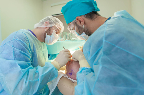 Leczenie łysienia. Przeszczep włosów. Chirurdzy w sali operacyjnej przeprowadzają operację przeszczepu włosów. Technika chirurgiczna, która przenosi mieszki włosowe z części głowy. - Zdjęcie, obraz