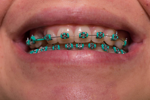 Zęby młodej kobiety z leczeniem ortodontycznym - Zdjęcie, obraz