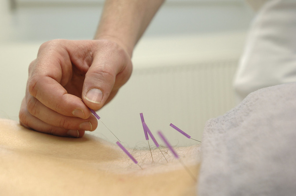 Akupunktur - Fotoğraf, Görsel