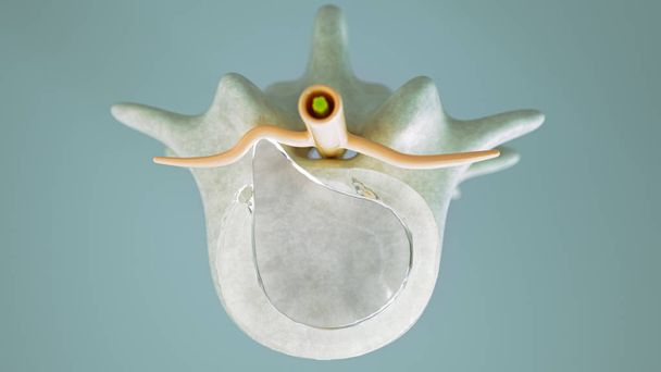 3Dレンダリングとしてのクローズアップとしての脊椎椎間板ヘルニア - 写真・画像