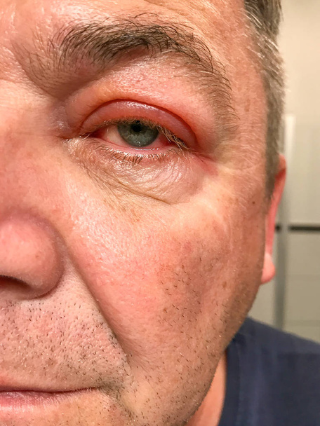 De cerca a un hombre con un ojo rojo inflamado
 - Foto, imagen