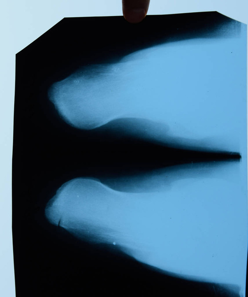 X-ray of feet and heel bones. X ray picture of bones. - Фото, изображение