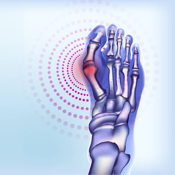 Romatoid artrit ile ayak kemikleri - Vektör, Görsel