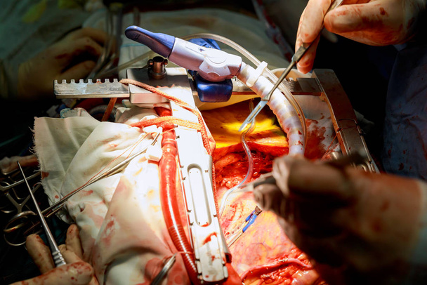 Хирург проводит шунтирование коронарной артерии, трансплантируя операцию на открытом сердце.
. - Фото, изображение