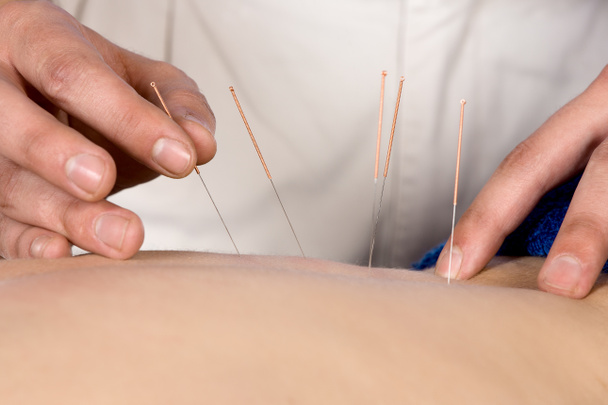 Physiotherapist doing accupuncture - Photo, Image