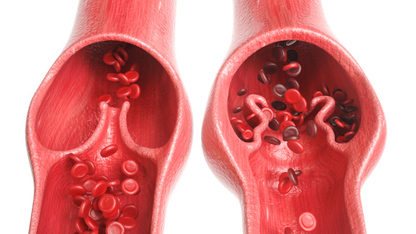 Veias varicosas em comparação com veias saudáveis - 3D Rendering
 - Foto, Imagem