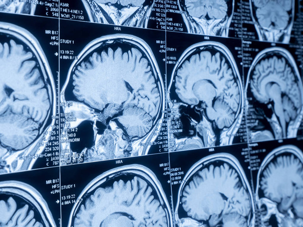 Obraz rezonansu magnetycznego (Mri) mózgu - Zdjęcie, obraz