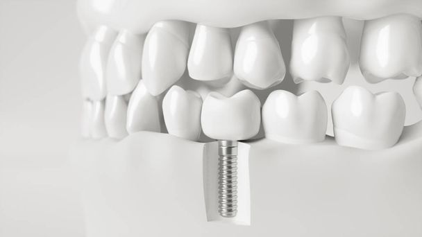 Um implante na mandíbula - renderização 3d
 - Foto, Imagem