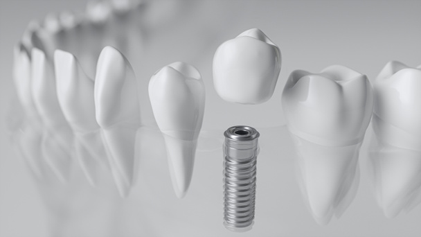 Um implante em uma mandíbula vítrea - 3D Rendering
 - Foto, Imagem