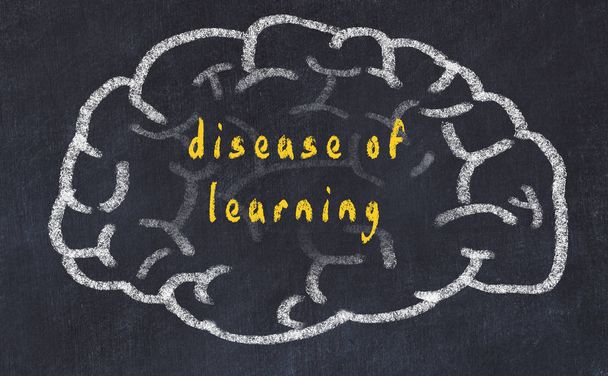 Soffio del cervello umano sulla lavagna con malattia di iscrizione di apprendimento
 - Foto, immagini