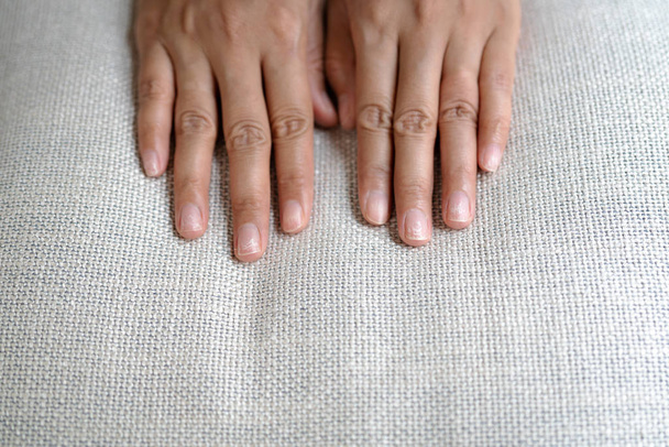 brüchig beschädigte Nägel nach Verwendung von Schellack oder Gel-Lack - Foto, Bild