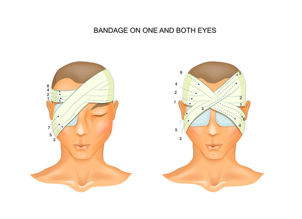 Verband auf einem und beiden Augen - Vektor, Bild