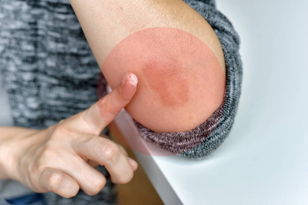 Problem chorób alergicznych skóry, zbliżenie atopowej wysypki skórnej, Kobieta Dermatologia pacjenta z alergicznym wypryskiem na ramieniu, Łuszczyca nawracające przez osłabienie i niezdrowe. - Zdjęcie, obraz