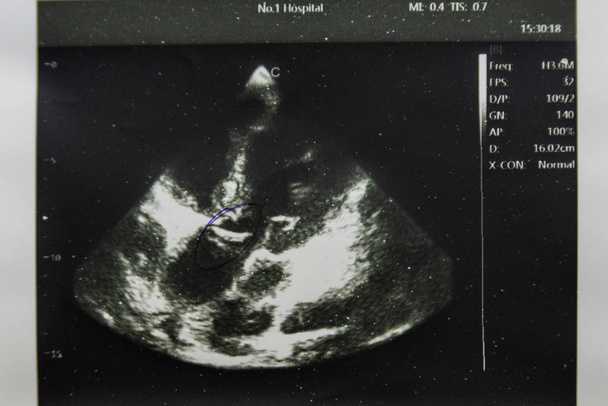 Imagen de ultrasonido cardíaco impresa en papel
 - Foto, Imagen