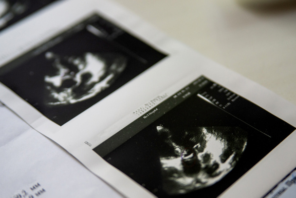 Imagen de ultrasonido cardíaco impresa en papel
 - Foto, Imagen