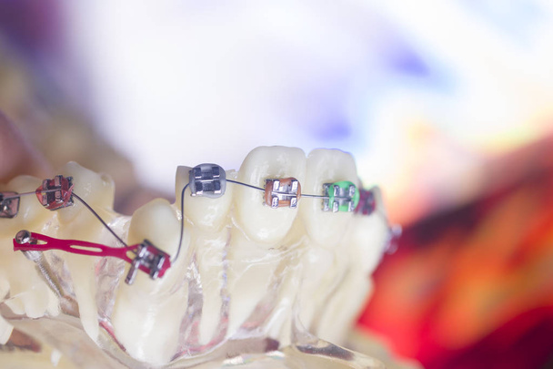 Supports dentaires redresseurs de dents
 - Photo, image