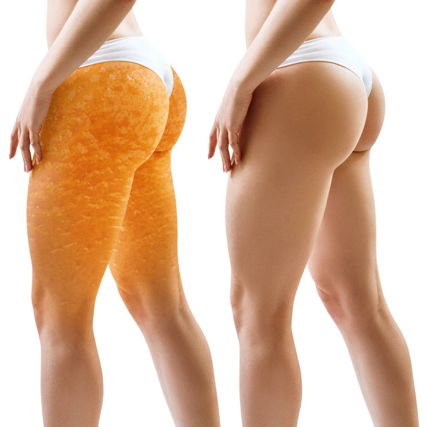 Buttocks with orange peel texture before and after tretment. - Photo, Image