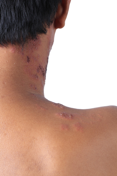 Herpes zoster nebo pásový opar nebo Zoster; příznak je infikován virem Varicella Zoster nebo VZV. je virové onemocnění charakterizované bolestivou kožní vyrážkou s puchýři v lokalizované oblasti. Vyrážka se vyskytuje v jedné části, široké svědění na boku těla - Fotografie, Obrázek
