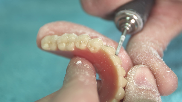 Стоматолог робить протез стоматологічного імплантату з гіпсового лиття
 - Кадри, відео