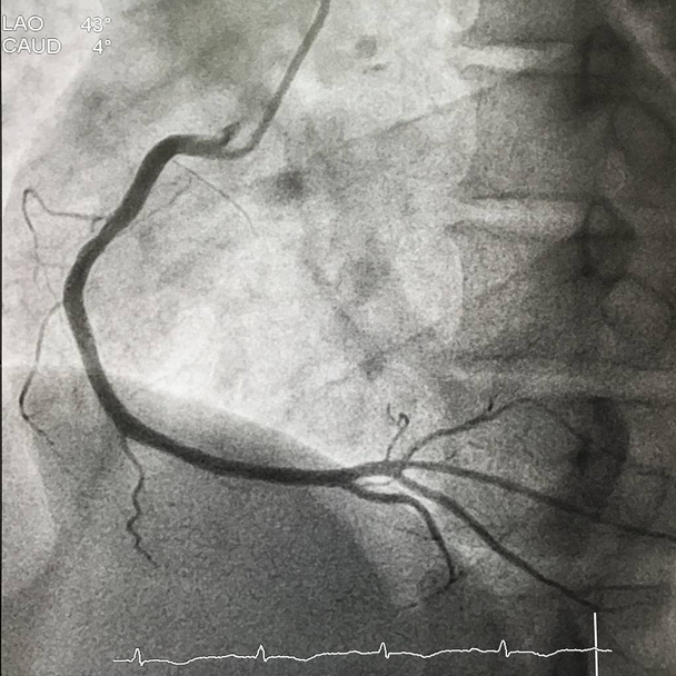 Um cine de artéria coronária direita normal na visão da OVA. Trata-se de uma artéria coronária de raios-x com angiografia estudo coronariano em laboratório de cateterismo do hospital centro cardíaco
. - Foto, Imagem