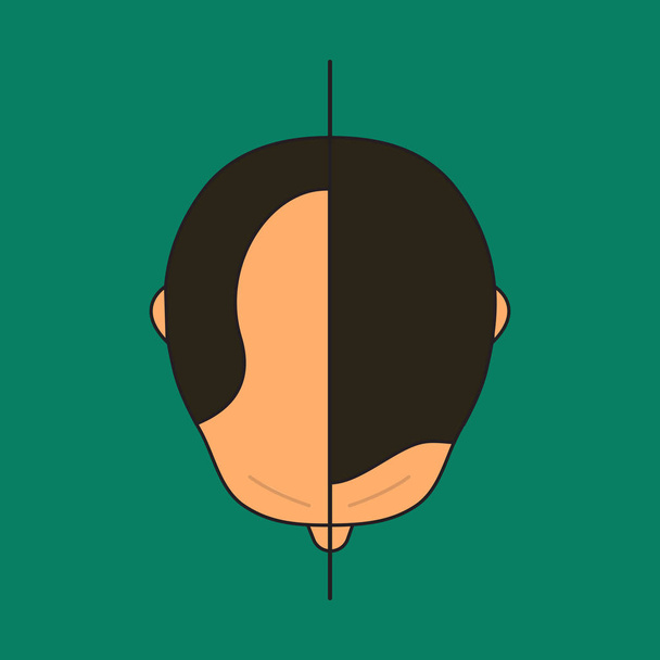 mannelijke alopecia, plastische chirurgie - Vector, afbeelding