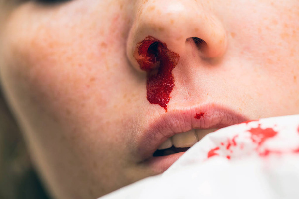 Sangrado nasal de la herida, hemorragia de la mujer por la nariz, lesión de la nariz sangre y tejido
 - Foto, Imagen