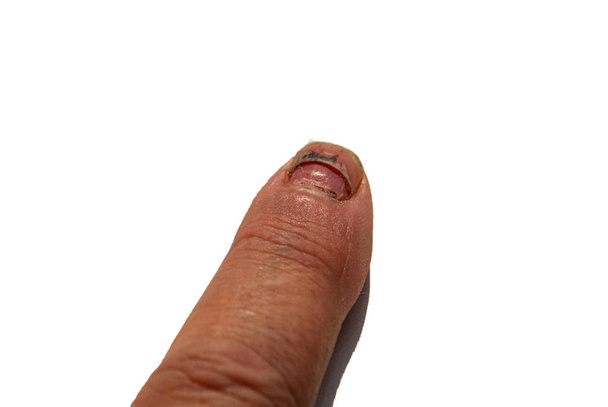 index finger and dying nail isolated on white background - Photo, Image