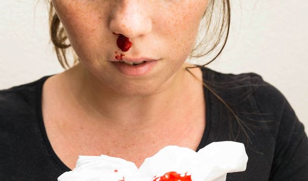 Кровотечение из носа, кровотечение из носа, травма носа, кровь и ткань
 - Фото, изображение