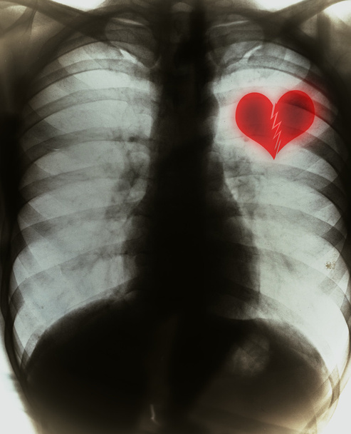 σπασμένη καρδιά στην ταινία μαύρο ακτίνας x - Φωτογραφία, εικόνα