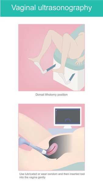 Ultrasonografía vaginal
.  - Vector, imagen