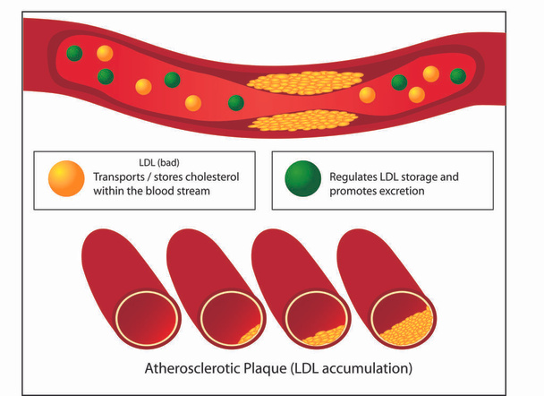 Hyvien ja huonojen lipidien ja ateroskleroottisen plakin osuus verisuonten lääketieteellisessä vektoriinfografiassa - Vektori, kuva