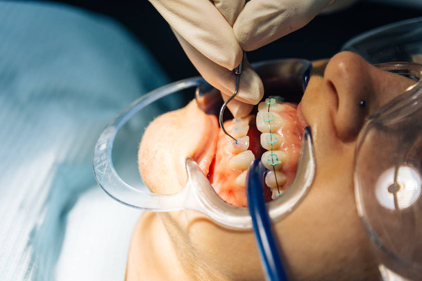 processo di collocazione di apparecchi dentali bianchi a una ragazza caucasica in una clinica dentale con una ragazza dentista
 - Foto, immagini