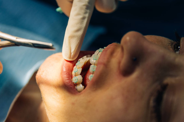 процес розміщення білих зубних брекетів на Кавказьку дівчину в стоматологічній клініці з стоматологiним дівчиною - Фото, зображення