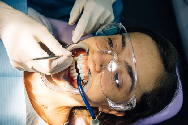 διαδικασία τοποθέτησης λευκών οδοντικών άγκιστρα σε μια καυκάσια κοπέλα σε μια οδοντιατρική κλινική με ένα κορίτσι οδοντίατρου - Φωτογραφία, εικόνα