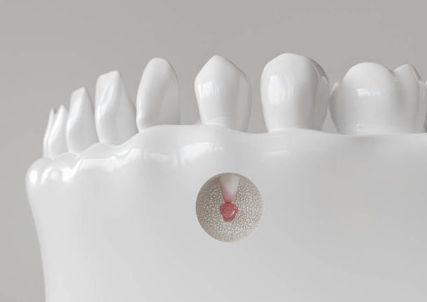 Inflamação da ponta radicular com apicectomia - renderização 3D
 - Foto, Imagem