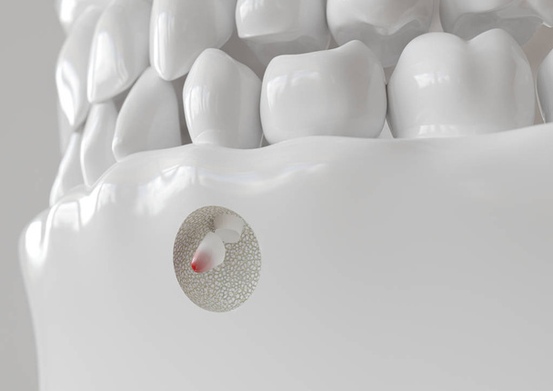 Root kärki tulehdus kanssa apicectomy - 3D renderöinti
 - Valokuva, kuva