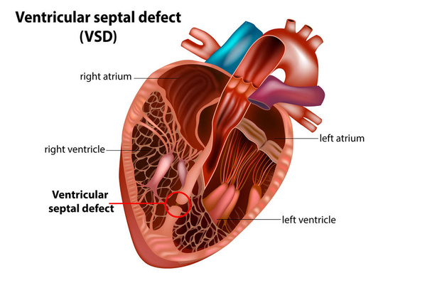 Ventriküler septal defekt (Vsd). Konjenital kalp defekti - Vektör, Görsel