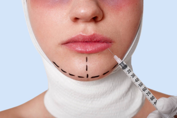 Half of face of beautiful young caucasian woman with perforation lines on chin before plastic surgery operation. Beautician holds syringe with injection, making procedures for improvement appearance. - Foto, Imagen
