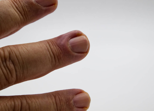 Blanco de infección en el dedo medio izquierdo de una mano
. - Foto, Imagen